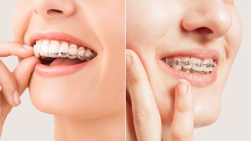 Braces vs. Aligners